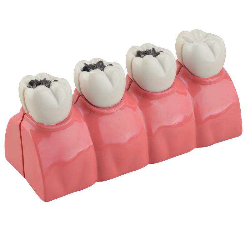 Dental Caries Model CBM-002C