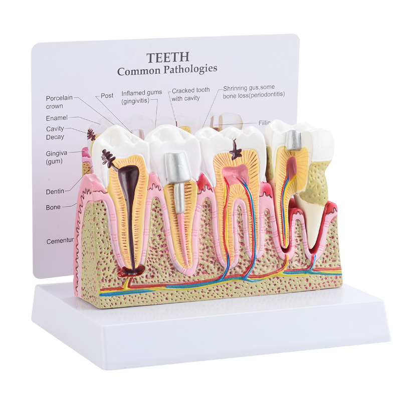 Teeth Common Pathologies Model CBM-002E